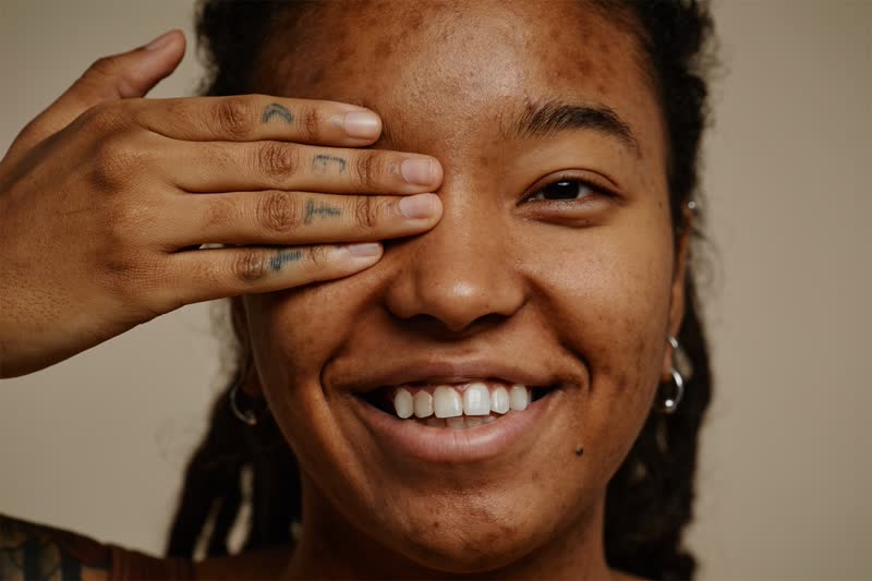 Acne-prone skin needs consistency more than intensity